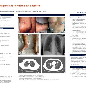 Cutaneous Larva Migrans and Asympotomatic Loefller’s Syndrome