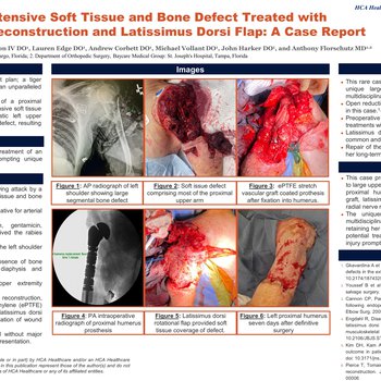 Tiger Attack Resulting in Extensive Soft Tissue and Bone Defect Definitively Treated with Total Shoulder Arthroplasty with Mega Prosthesis and Latissimus Dorsi Flap: A Case Report
