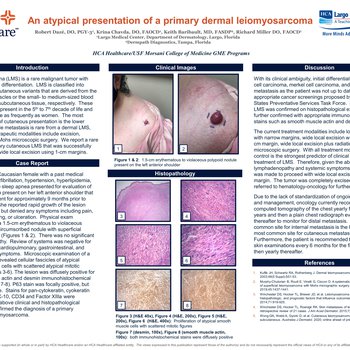 An Atypical Presentation of a Primary Dermal Leiomyosarcoma