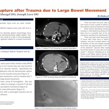 Delayed Splenic Rupture After Trauma Due to Large Bowel Movement