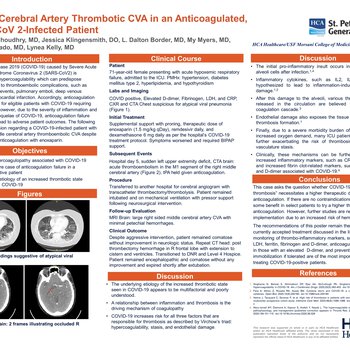 Middle Cerebral Artery Thrombotic CVA in an Anticoagulated, SARS-CoV 2 Infected Patient