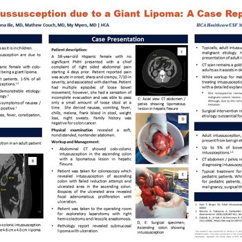 Colo-colonic Intussuseption Due to a Giant Lipoma: A Case Report