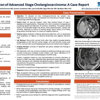 An Atypical Presentation of Advanced Stage Cholangiocarcinoma