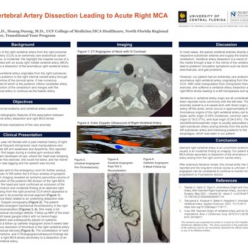 Right Vertebral Artery Dissection Leading to Acute Right MCA Stroke