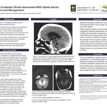 Bilateral Cerebellar Stroke Associated With Opiate Abuse: Evaluation and Management