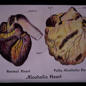 Alcoholic heart