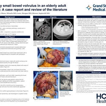 Primary Small Bowel Volvulus in an Elderly Adult Female: A Case Report and Review of the Literature