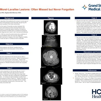 Traumatic Morel-Lavallee Lesions: Often Missed but Never Forgotten