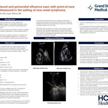 Large Pleural and Pericardial Effusions Seen with Point-of-care Ultrasound in the Setting of New Onset Lymphoma
