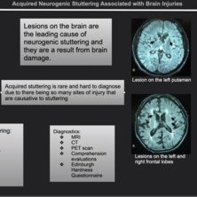 Acquired Neurogenic Stuttering Associated With Traumatic Brain Injury and Stroke